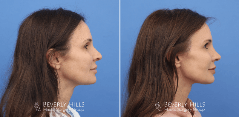 Before x After 043