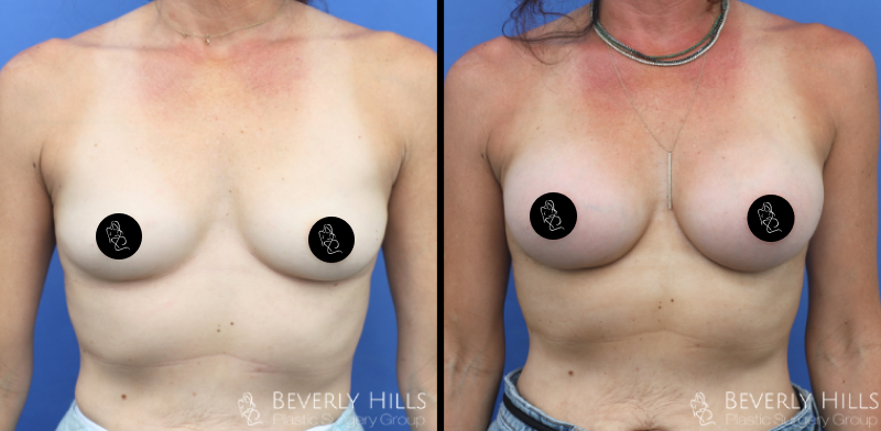 Before x After 10