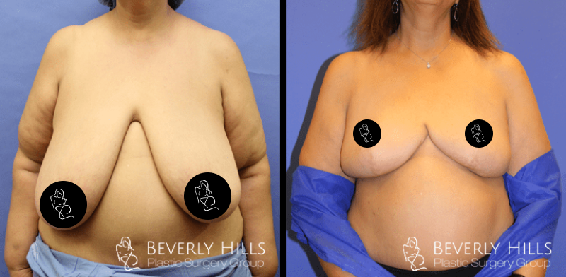 Before x After 25