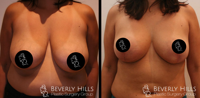 Before x After 26