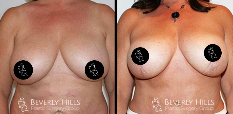Before x After 29