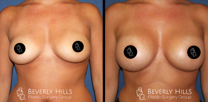 Before x After 3