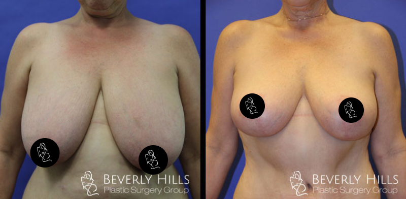 Before x After 30