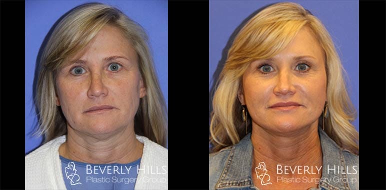 Facelift-Eyelid-Necklift-Co2-front-1