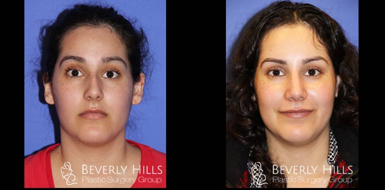 Female-Ethnic-Rhinoplasty-front-5