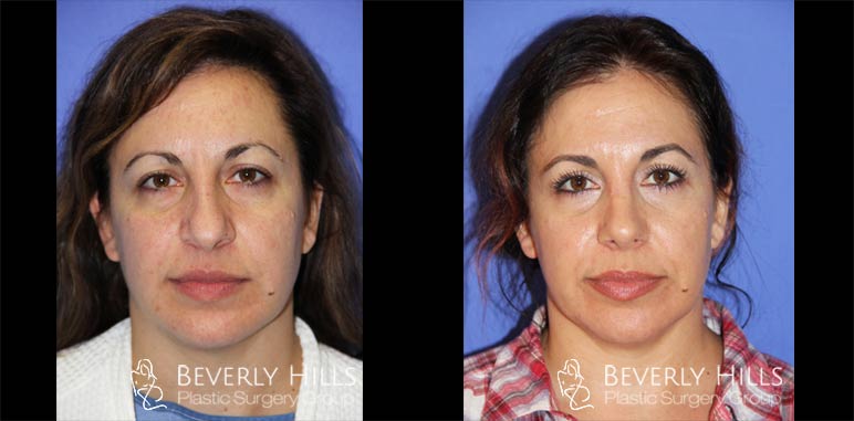 Female-Ethnic-Rhinoplasty-front