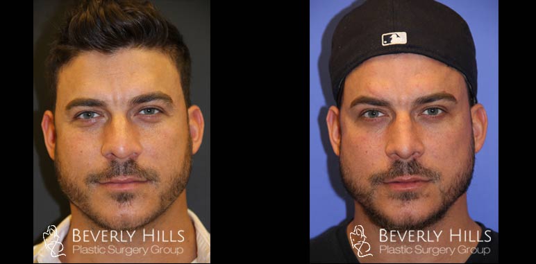 Male-Rhinoplasty-case-17-front