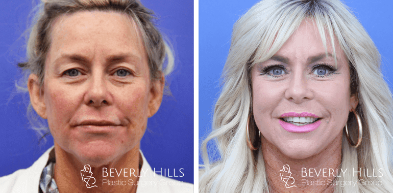 facelift-before-after-front-12-min