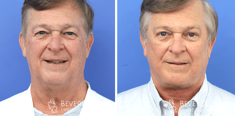 facelift-before-after-front-13-min