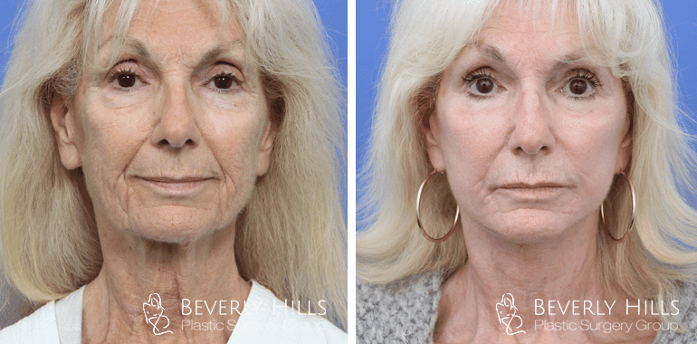facelift-before-after-front-2