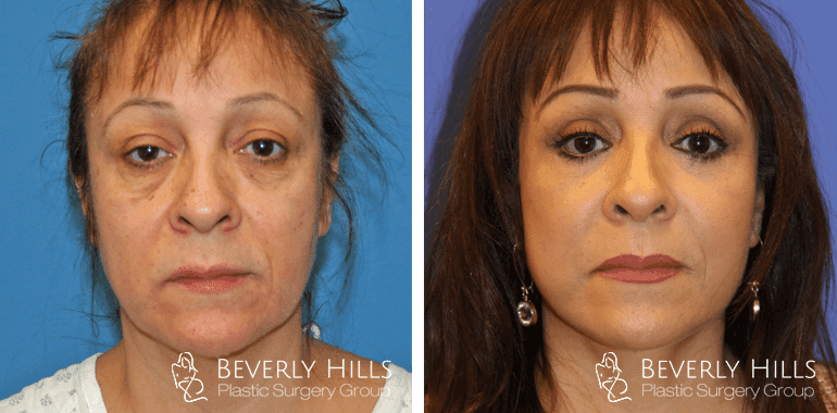 facelift-front-1-min