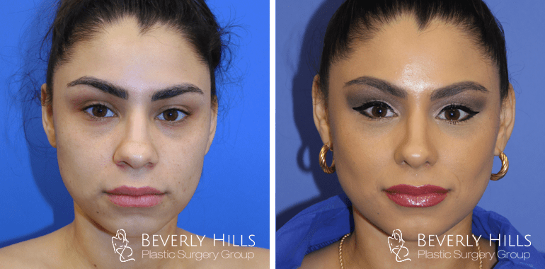 rhinoplasty-before-after-front-4