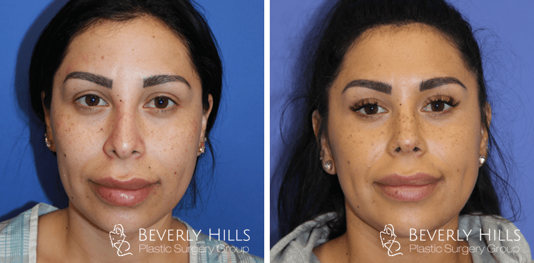 rhinoplasty-before-after-front-5