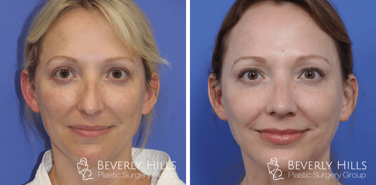 rhinoplasty-before-after-front-7-1
