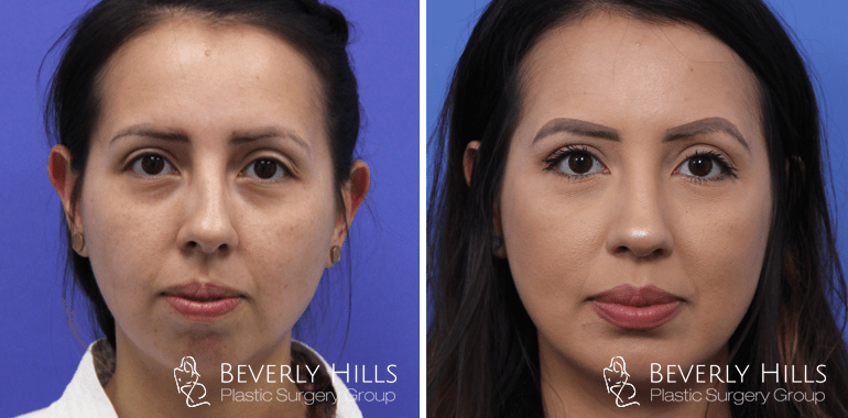 rhinoplasty-before-after-front-case-10