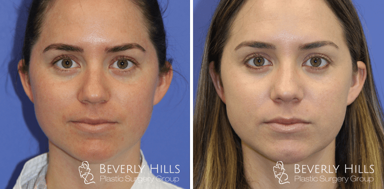 rhinoplasty-before-after-front-case13