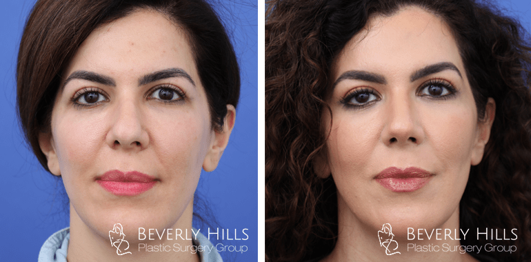 rhinoplasty-front-6-min