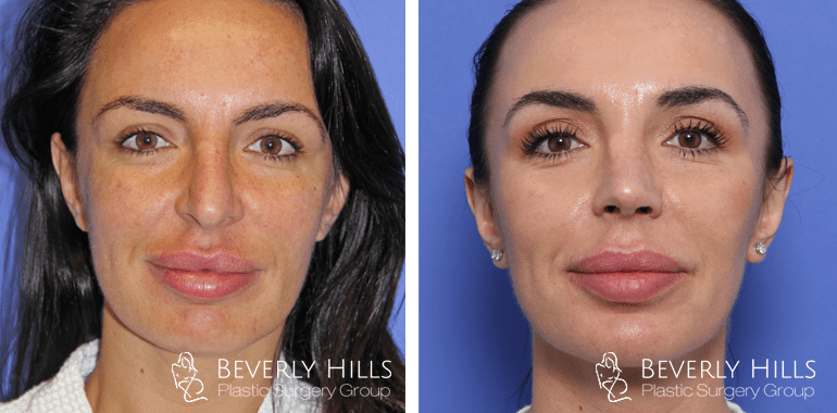rhinoplasty-front-case1-min