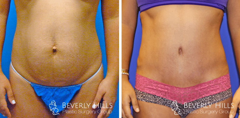 tummy-tuck-front-4-min